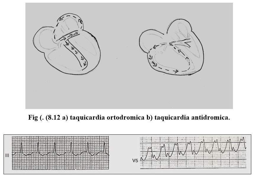 arritmia11